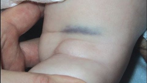 Unexplained Bruising Weighing The Pros And Cons Of Possible Causes Unexplained Bruising Weighing The Pros And Cons Of Possible Causes