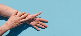 Navigating monkeypox in children