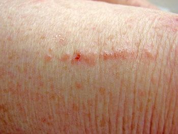 Cauliflower Rash Plant Contact Dermatitis