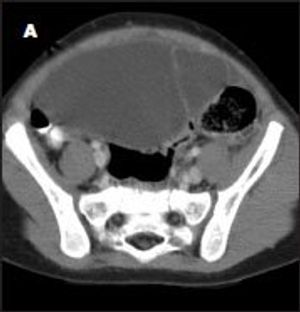 Omental Cyst Presenting as Acute Abdomen