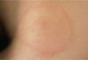 What Is This Annular Rash?