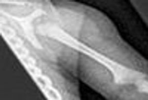 Shoulder Dislocation in a Neonate