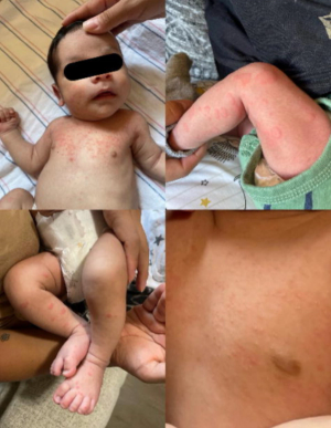 Full case study: Urticarial rash in a 9-hours-old male