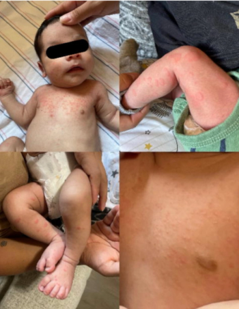 Puzzler poll: Urticarial rash in a 9-hours-old male | Image credit: Provided by case authors