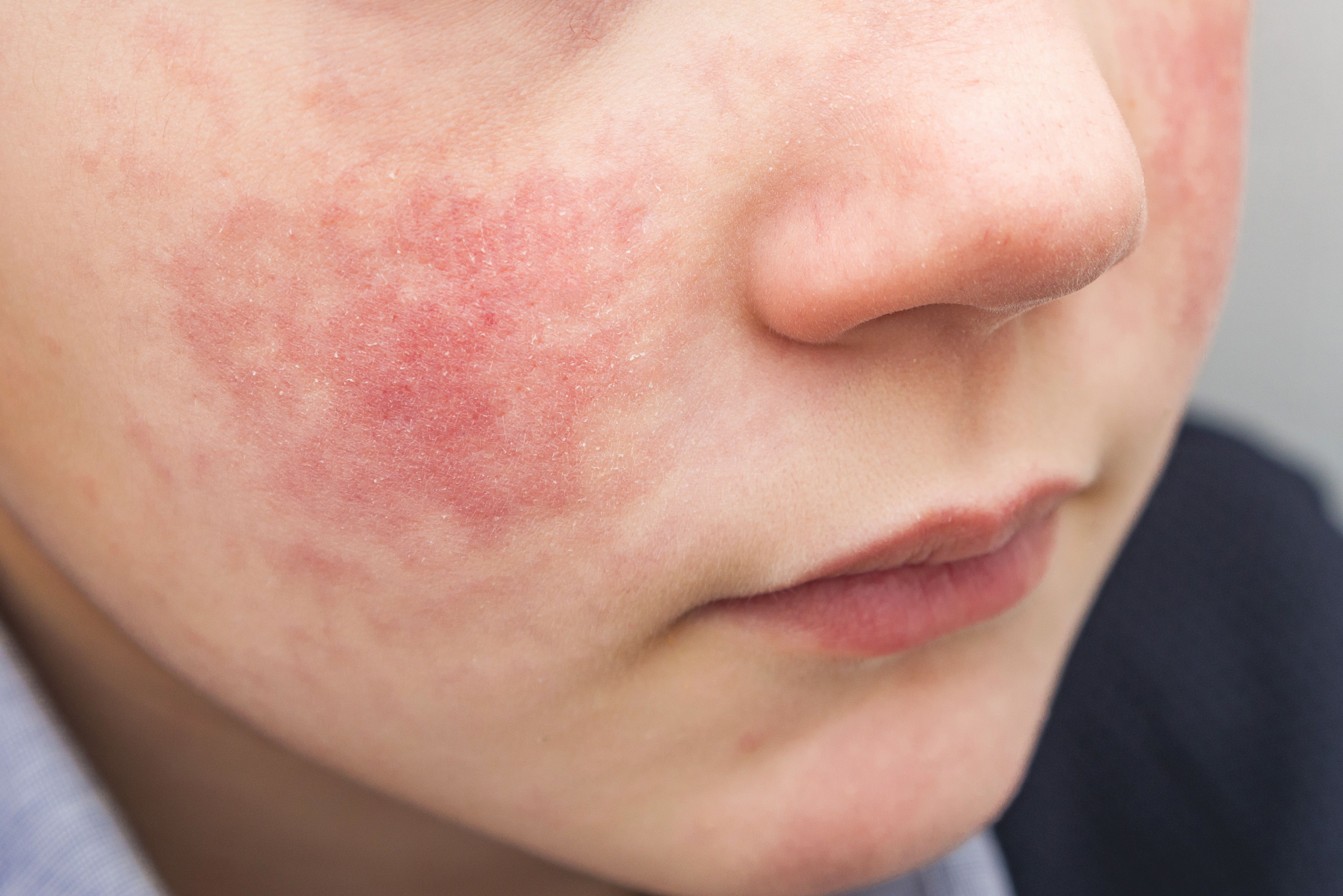 AAD issues pediatric atopic dermatitis guidelines for optimal patient care | Image Credit: © Evgen - © Evgen - stock.adobe.com.