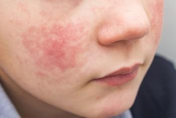 AAD issues pediatric atopic dermatitis guidelines for optimal patient care | Image Credit: © Evgen - © Evgen - stock.adobe.com.