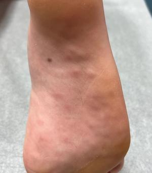 Case study: Boy, aged 10 years, has painful nodules on his feet