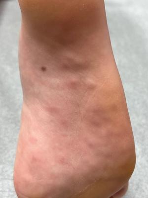 Case study: Boy, aged 10 years, has painful nodules on his feet