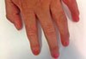 Dyskeratosis Congenita: An Inherited Bone Marrow Failure Syndrome