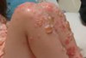 Chronic Bullous Disease of Childhood