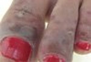 An Active 15-Year-Old Girl With a Rash on Both Feet