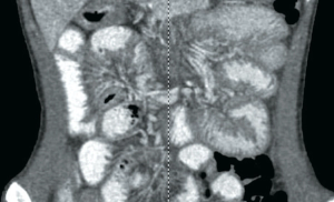 Teenager suffers diarrhea, emesis, and weight loss