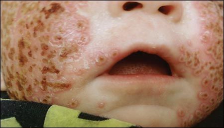 Eczema Herpeticum With Mrsa Superinfection