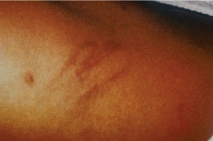 Uncharacteristic skin findings in a toddler with a history of dermatitis