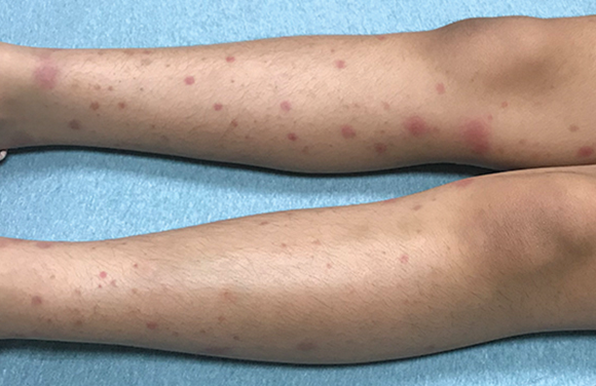 Painful Rash On Lower Leg