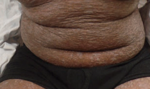 Generalized, eruptive lichen planus in a pediatric patient