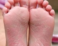 bottom of feet dry and peeling