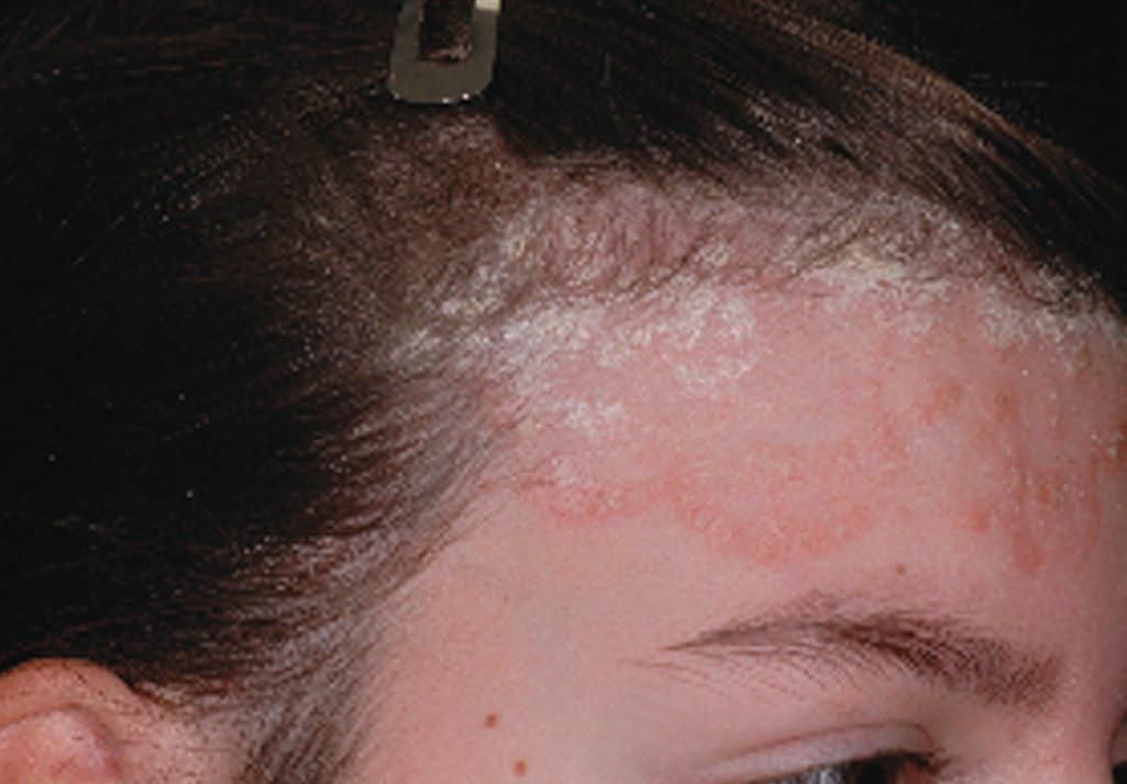Scalp Psoriasis in a 13-Year-Old Girl