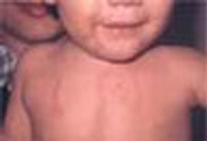 Photoclinic: Phytophotodermatitis