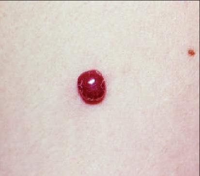 what is spitz melanoma