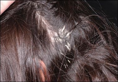 Is this a dermatophyte infection of the scalp?