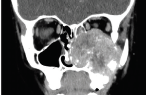 Six-year-old male with acute eye swelling and drainage