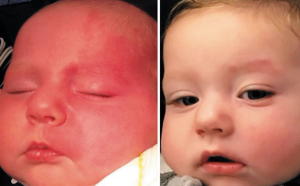 baby with port wine stain