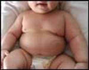 Infant With Multiple Birthmarks and Hypertrophic Left Arm