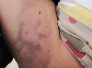 Puncture wounds and purpura