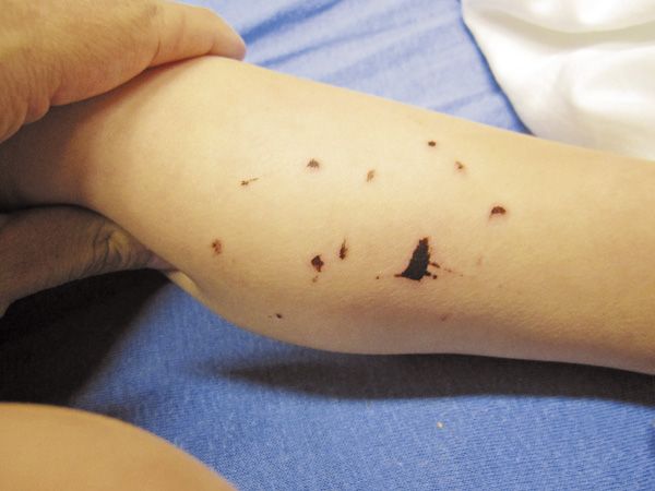 Black Spots On A Toddler S Skin