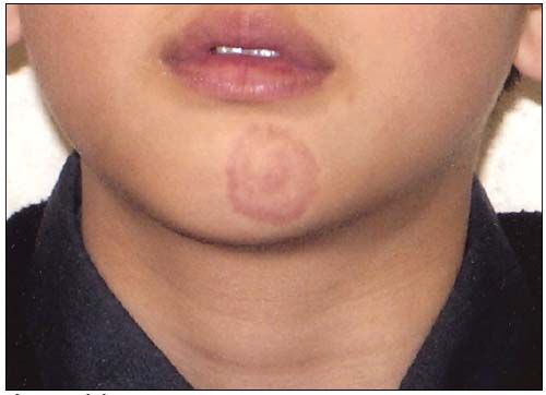 ringworm cheek