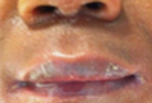 Staphylococcal Scalded Skin Syndrome in a 5-Year-Old Boy