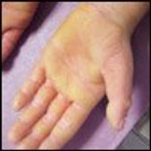 Boy With Thick Plaques on His Palms and Soles