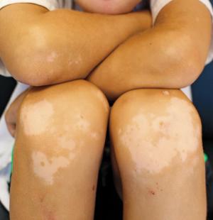 Boy’s white patches signal pigmentary disorder