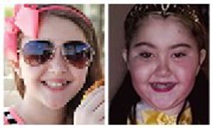 Girl presents with facial edema after surgery