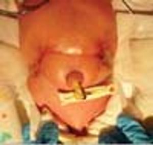 Aplasia Cutis Congenita With Associated Fetus Papyraceus