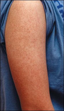 Teenager With Small Red Papules On Her Arms And Thighs