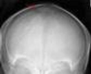 A Wormian Bone in a Neonate