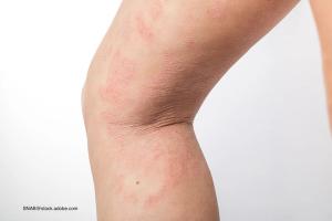 Dupilumab is effective in treating AD in patients aged 6 months to 5 years