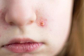 Recognizing and managing allergic skin conditions across pediatric populations | Image Credit: © stopabox - stock.adobe.com
