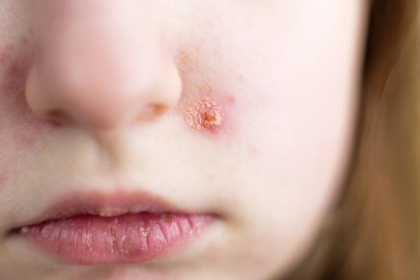 Recognizing and managing allergic skin conditions across pediatric populations | Image Credit: © stopabox - stock.adobe.com