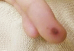 Fever, headache, arthralgias, and rash