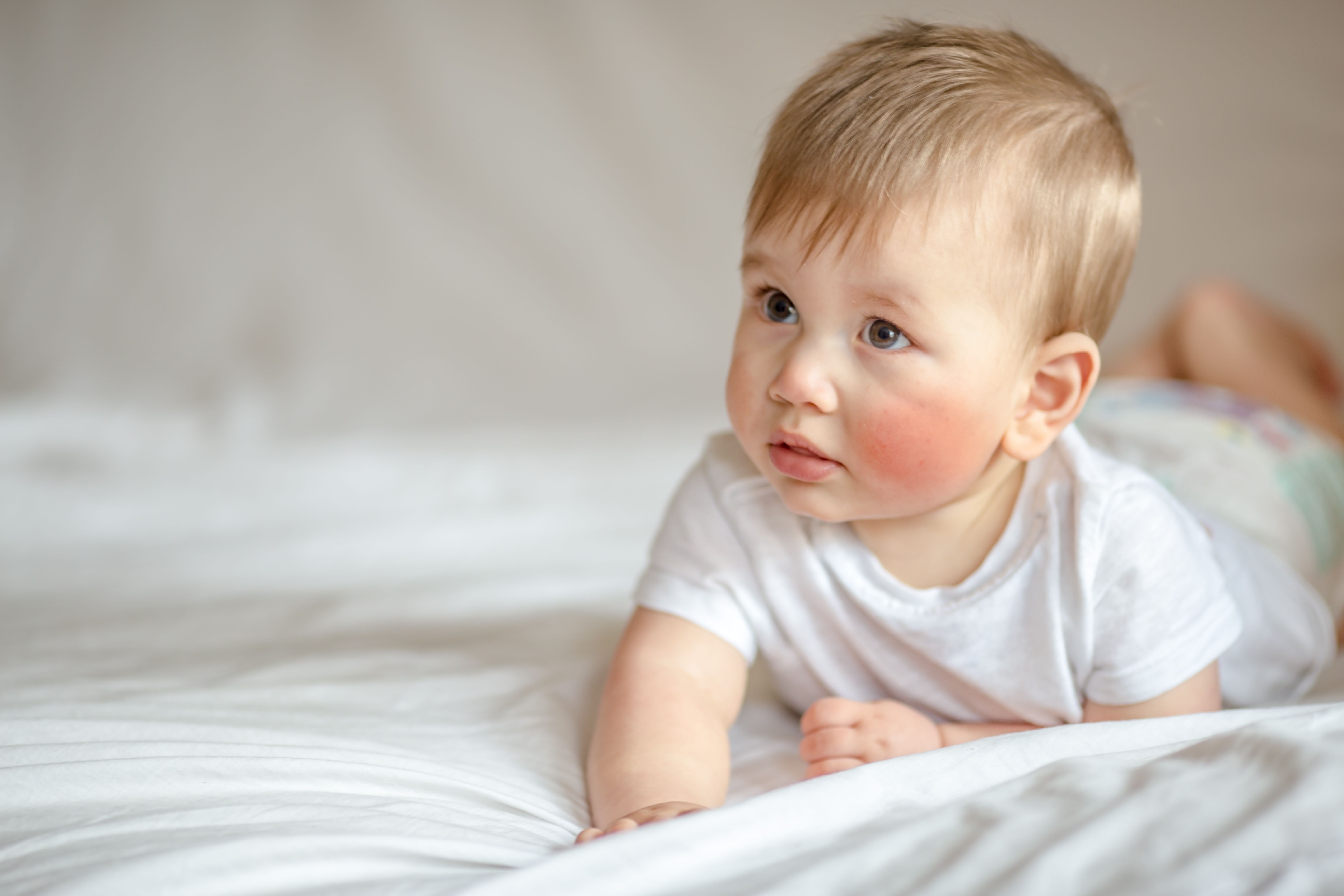 First infant enrolled in trial of roflumilast 0.05% for atopic dermatitis in infants | | Image Credit: © Dinko - © Dinko- stock.adobe.com.