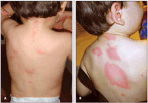 Acute Urticaria