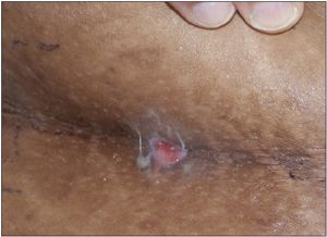Teen With Multiple Boils Teen With Multiple Boils