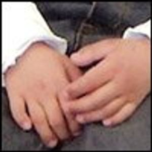 Translocation Down (Trisomy 21) Syndrome