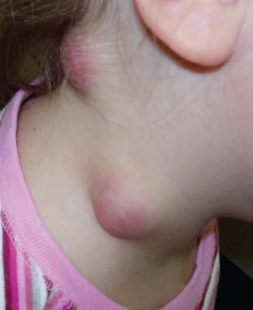 Tularémie chez une fille de 4 ans