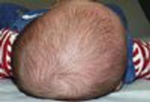 Positional Plagiocephaly, Part 1:A Practical Guide to Evaluation