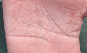 Girl’s hands shrivel when exposed to water