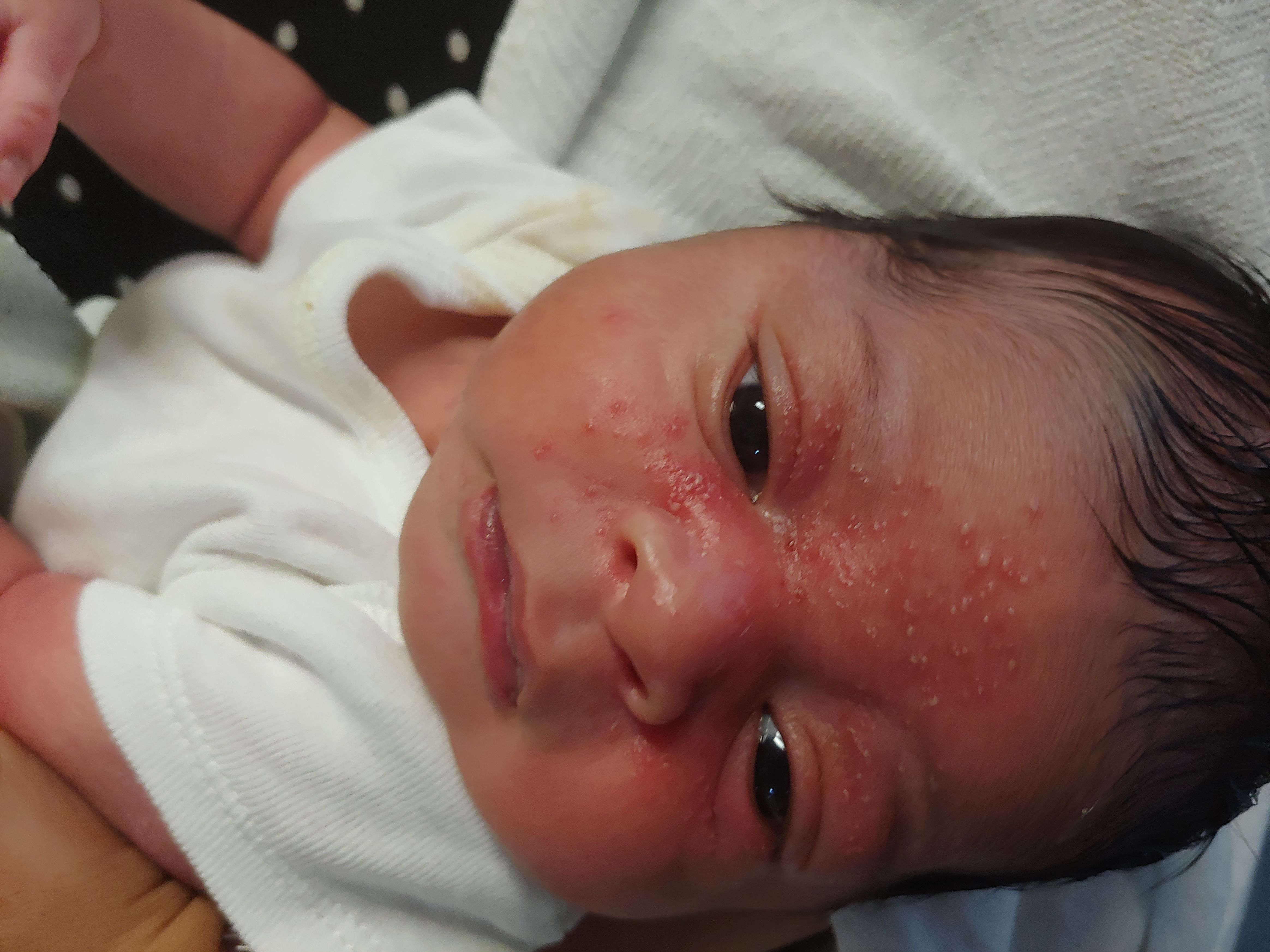 Newborn's rash eyes and nose